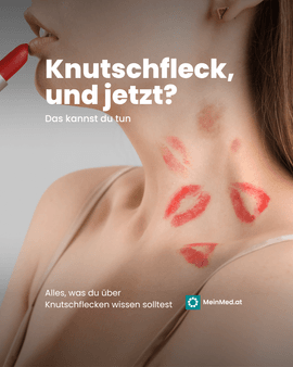 Knutschlfeck wegbekommen