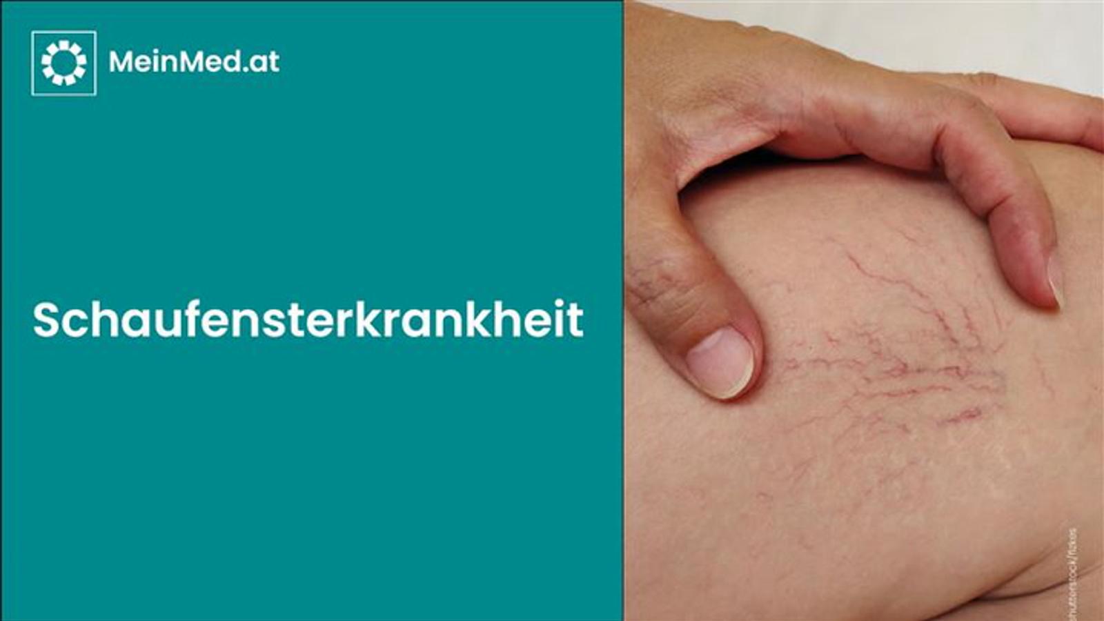 Schaufensterkrankheit