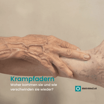 Krampfadern