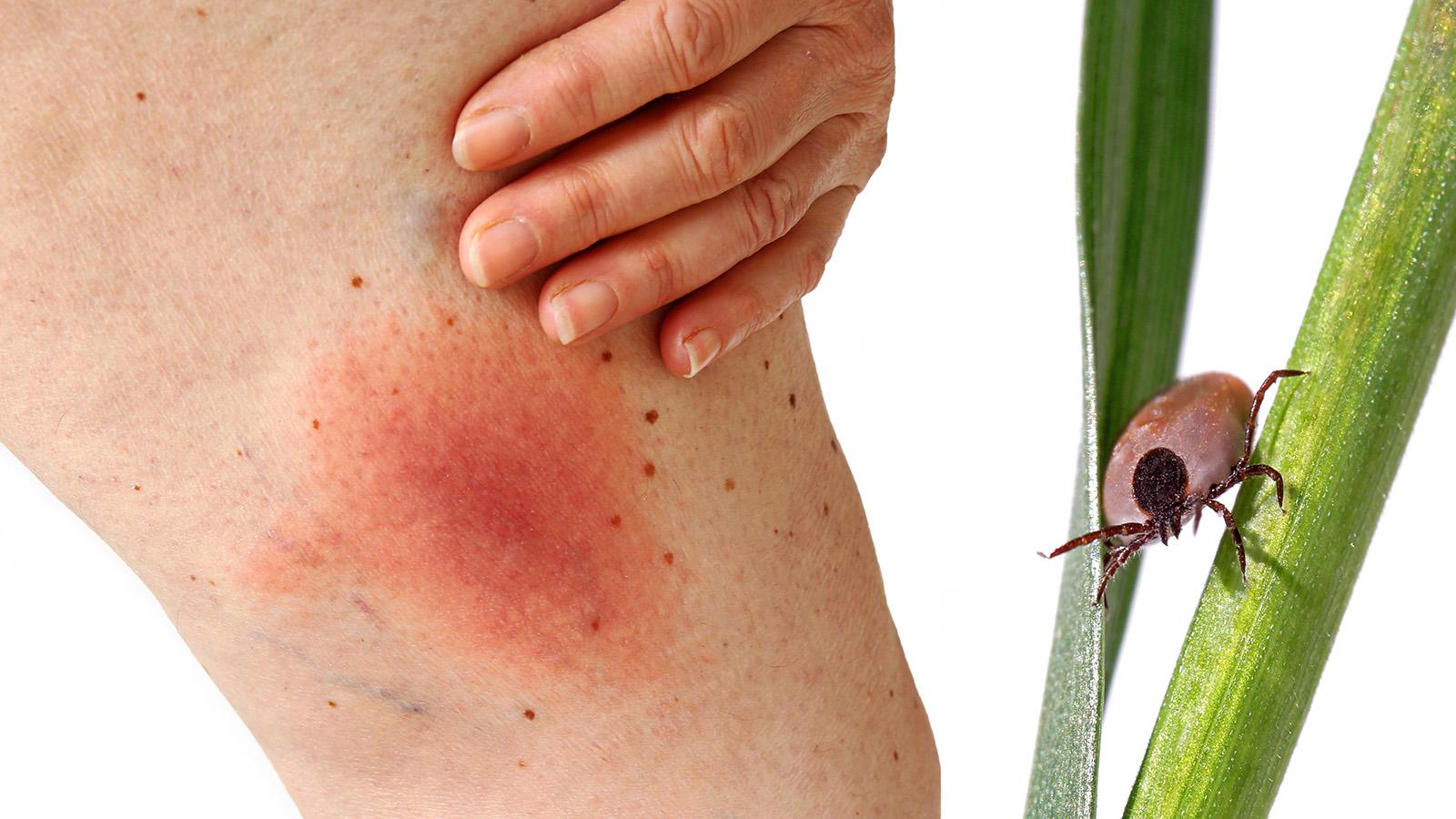 Borreliose-Hautausschlag am Bein, daneben Zecke auf einem Grashalm