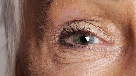 Auge einer älteren Frau mit Makuladegeneration