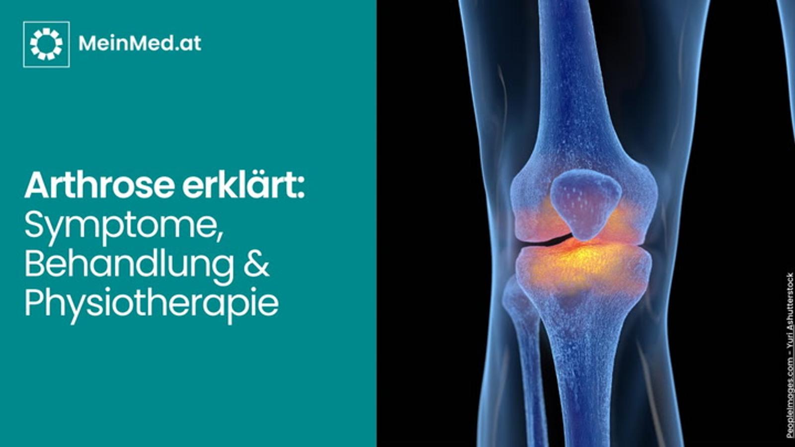 Arthrose verständlich erklärt