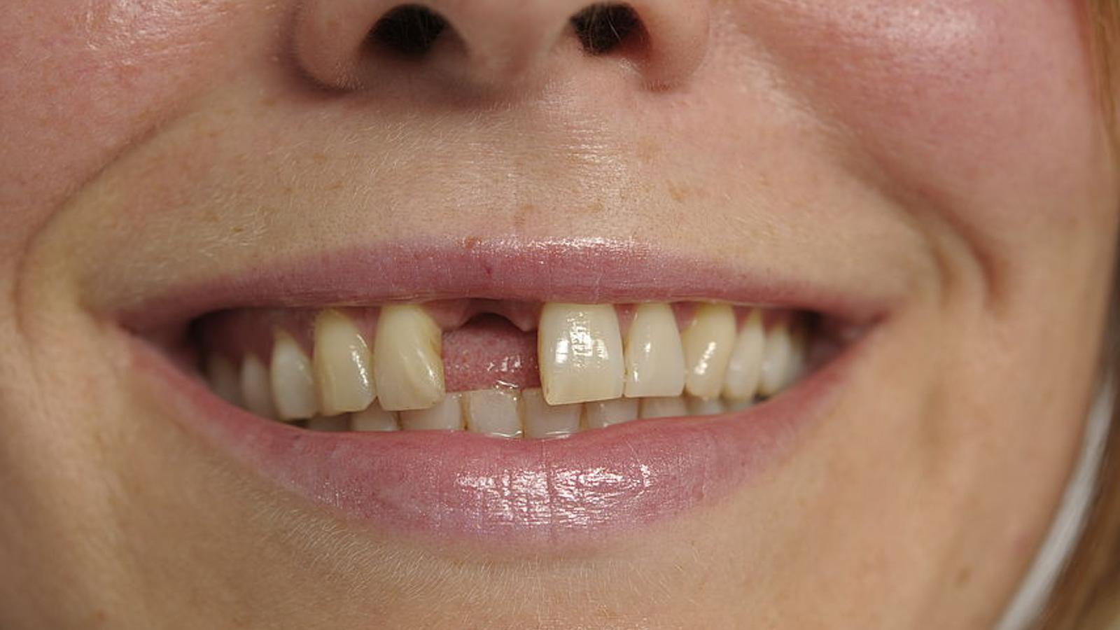 Zahnverlust: Frau mit Zahnlücke