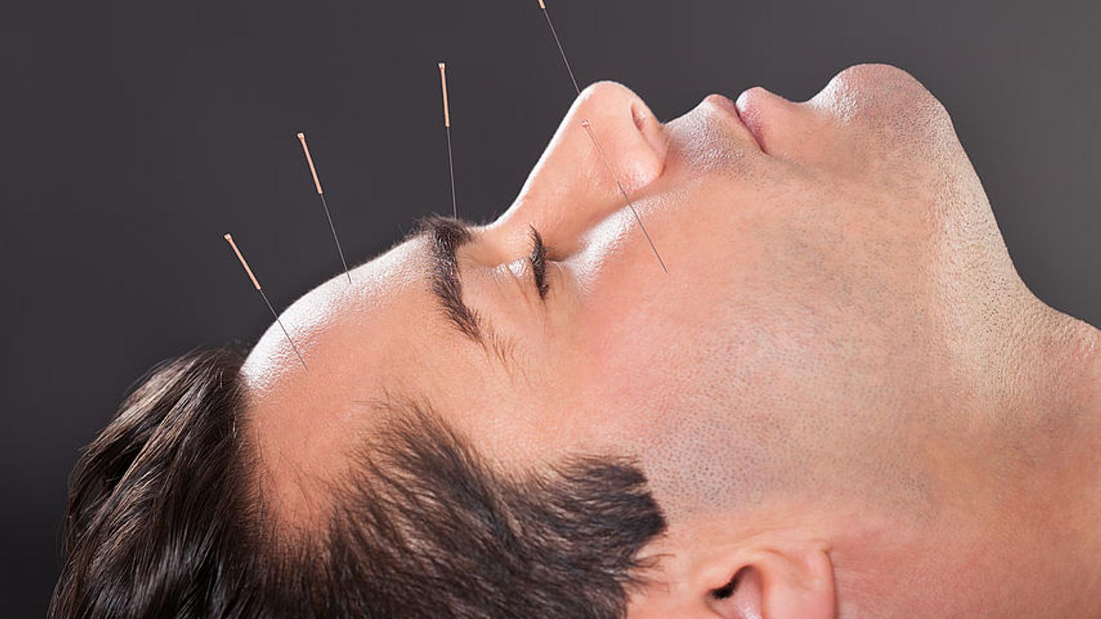 Mann mit Kopfschmerzen hat Akupunktur-Nadeln im Gesicht