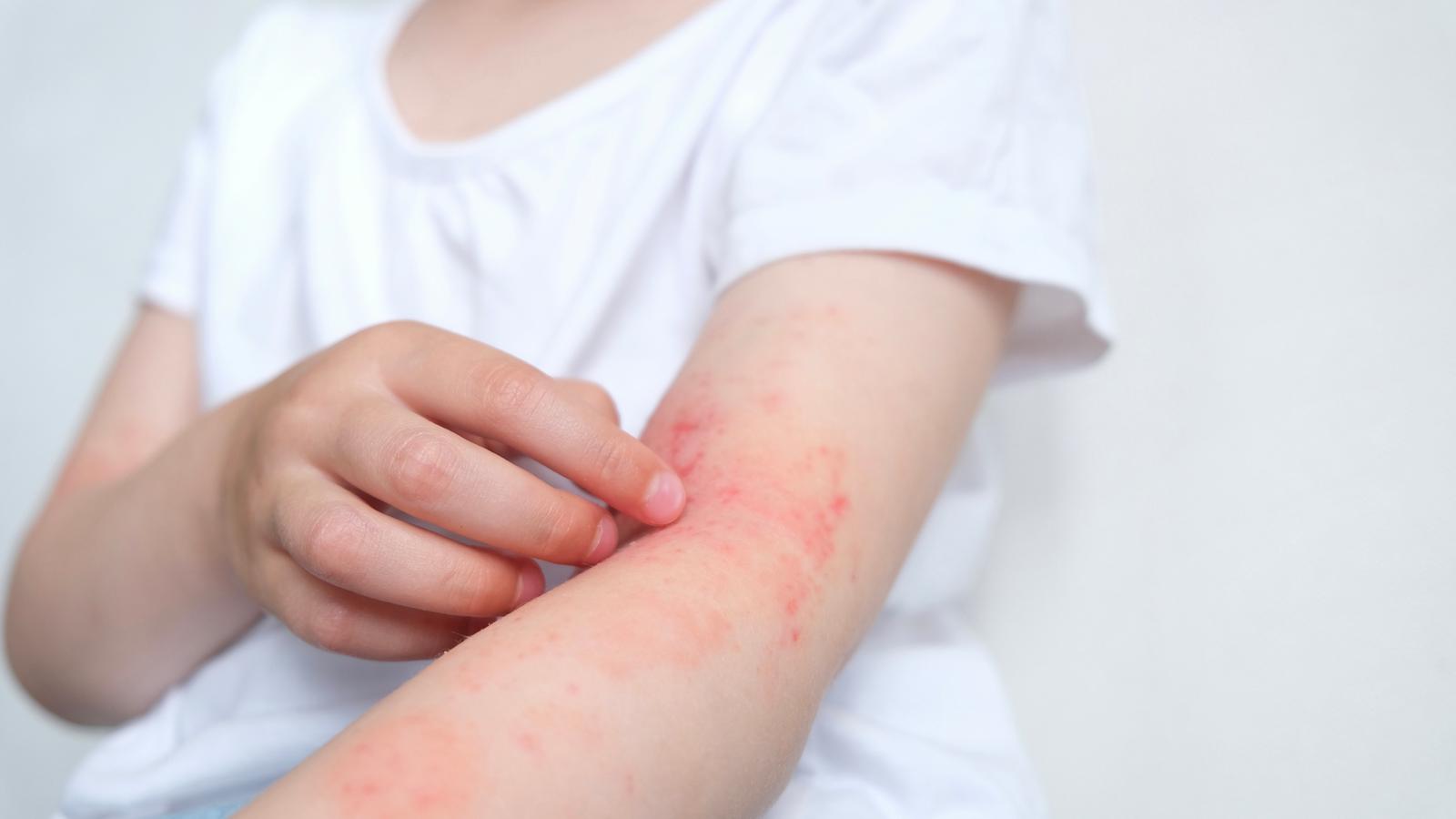 Atopische Dermatitis: Alle Zeichen stehen auf Entzündung