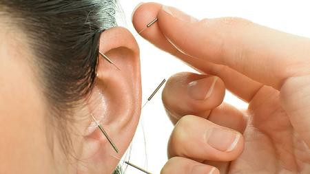 Frau wird eine Akupunkturnadel ins Ohr gesetzt. 
