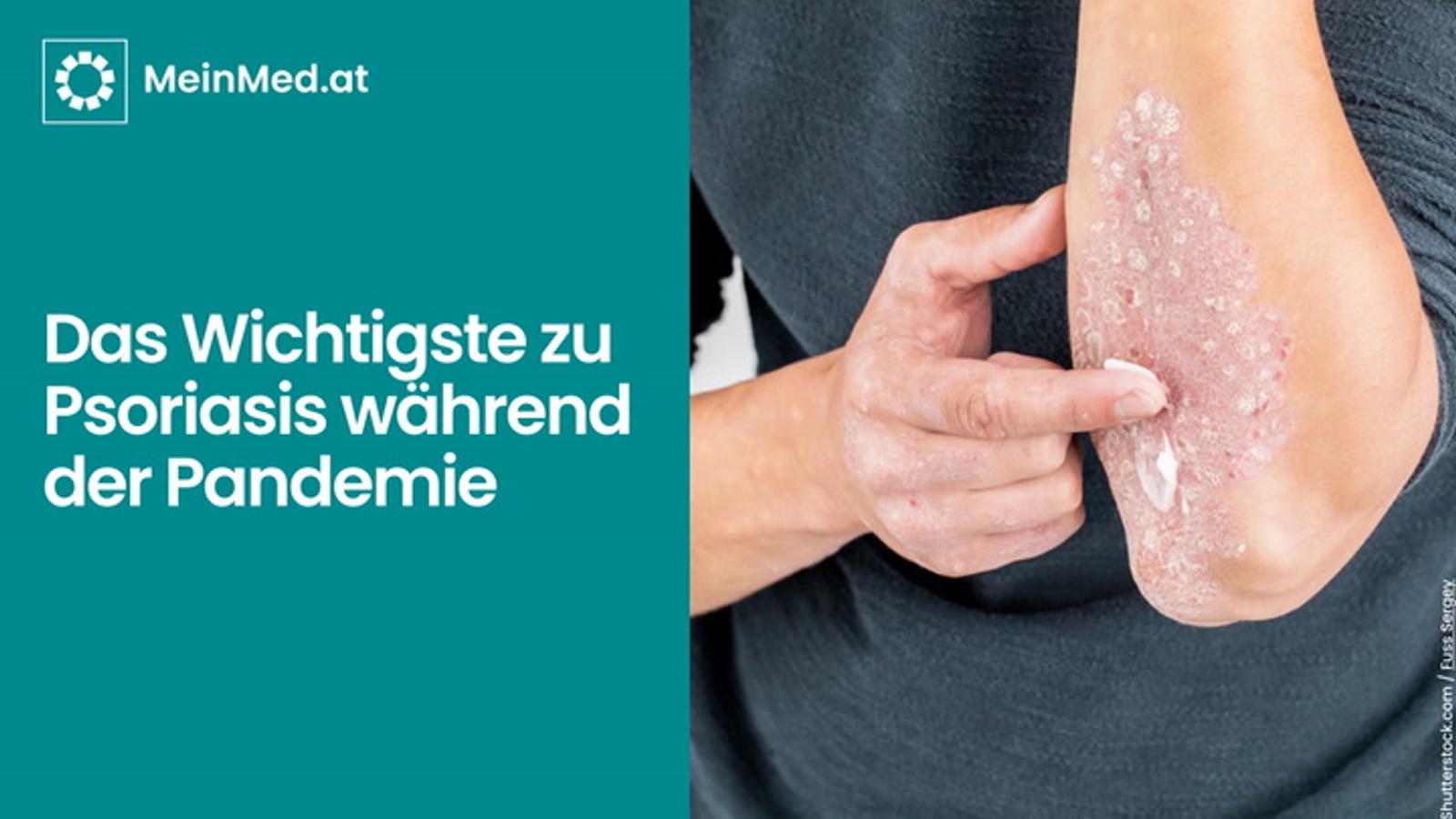 Das Wichtigste zu Psoriasis während der Pandemie