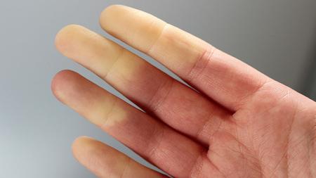 Erkaltete und blasse Hände eines Menschen mit Gefäßerkrankung
