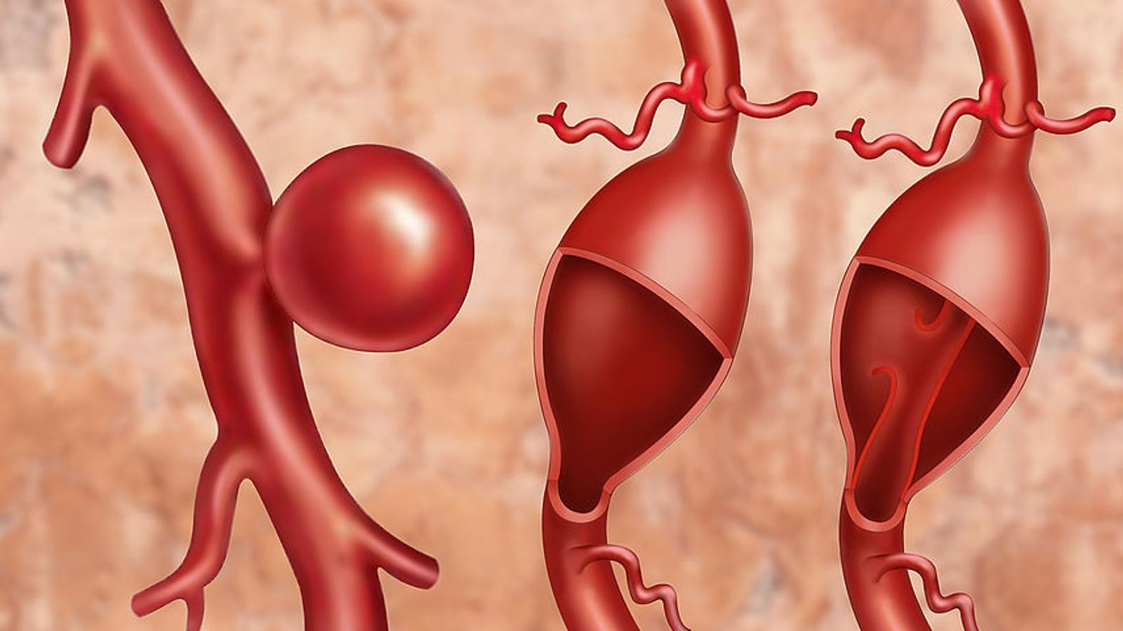 Arterien mit verschiedenen Arten des Aneurysma