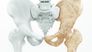 Wenn die Knochen schwinden: Prophylaxe, Diagnose und Therapie der Osteoporose
