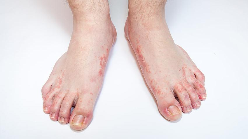 Fußpilz » Ursachen, Symptome und Behandlung | MeinMed.at