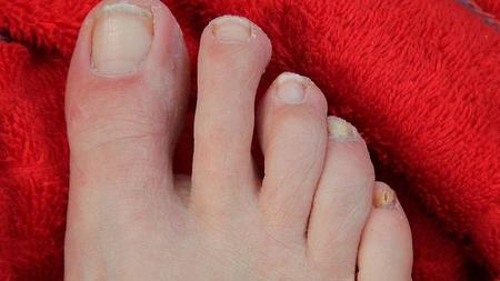 Abbildung Fuß mit Hautpilz