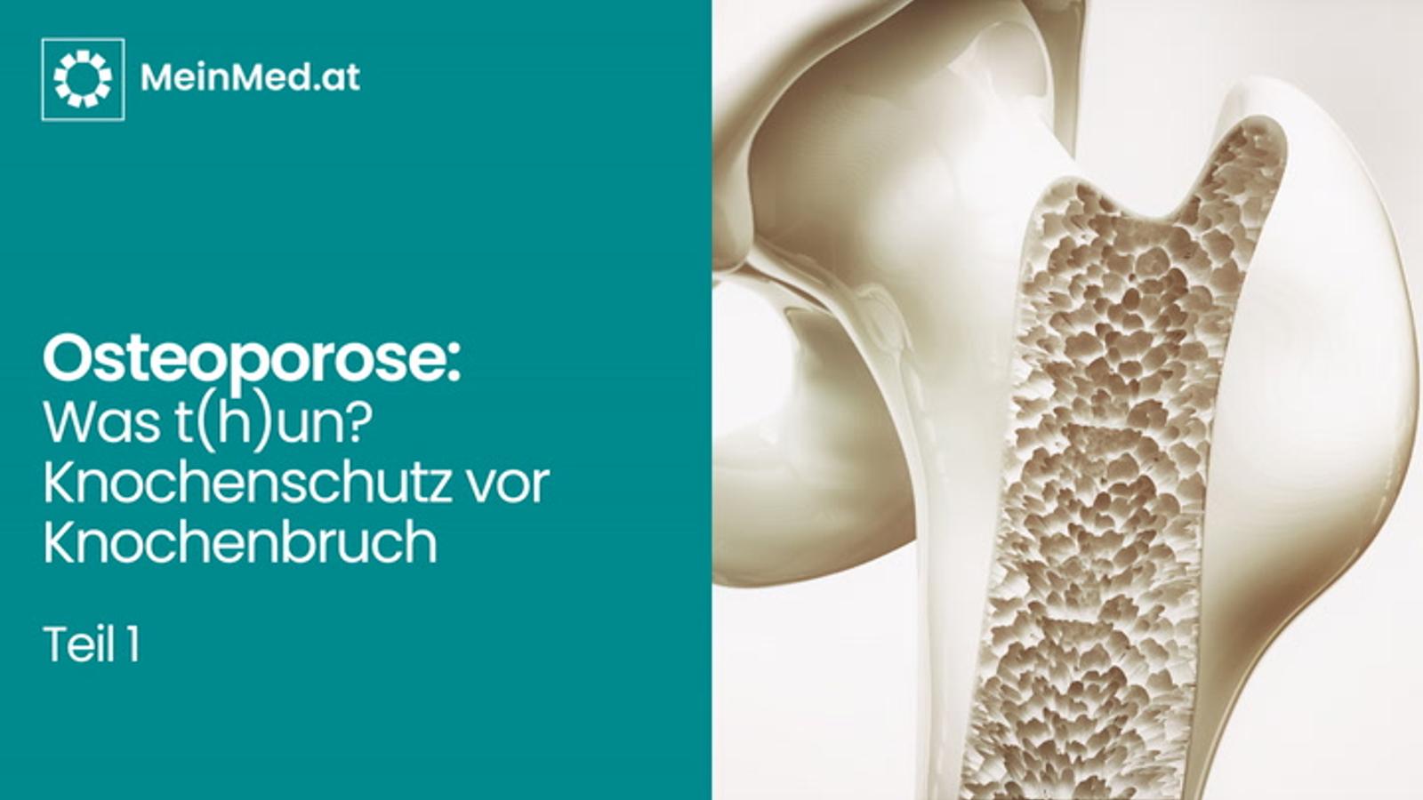 Osteoporose: Was T(h)un? – KnochenSCHUTZ vor KnochenBRUCH!