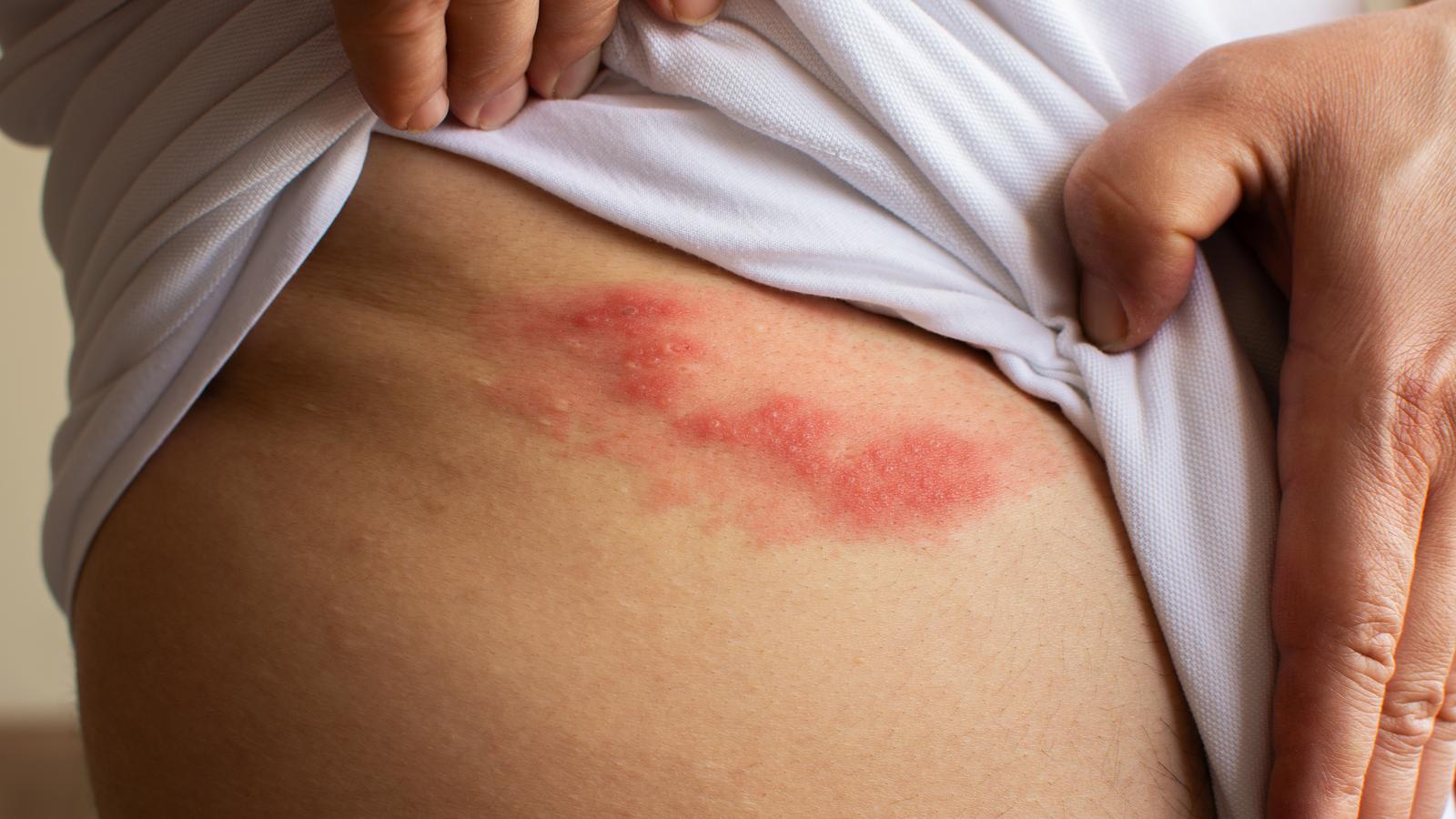 Person zeigt den Gürtelrose-Ausschlag am Oberkörper.