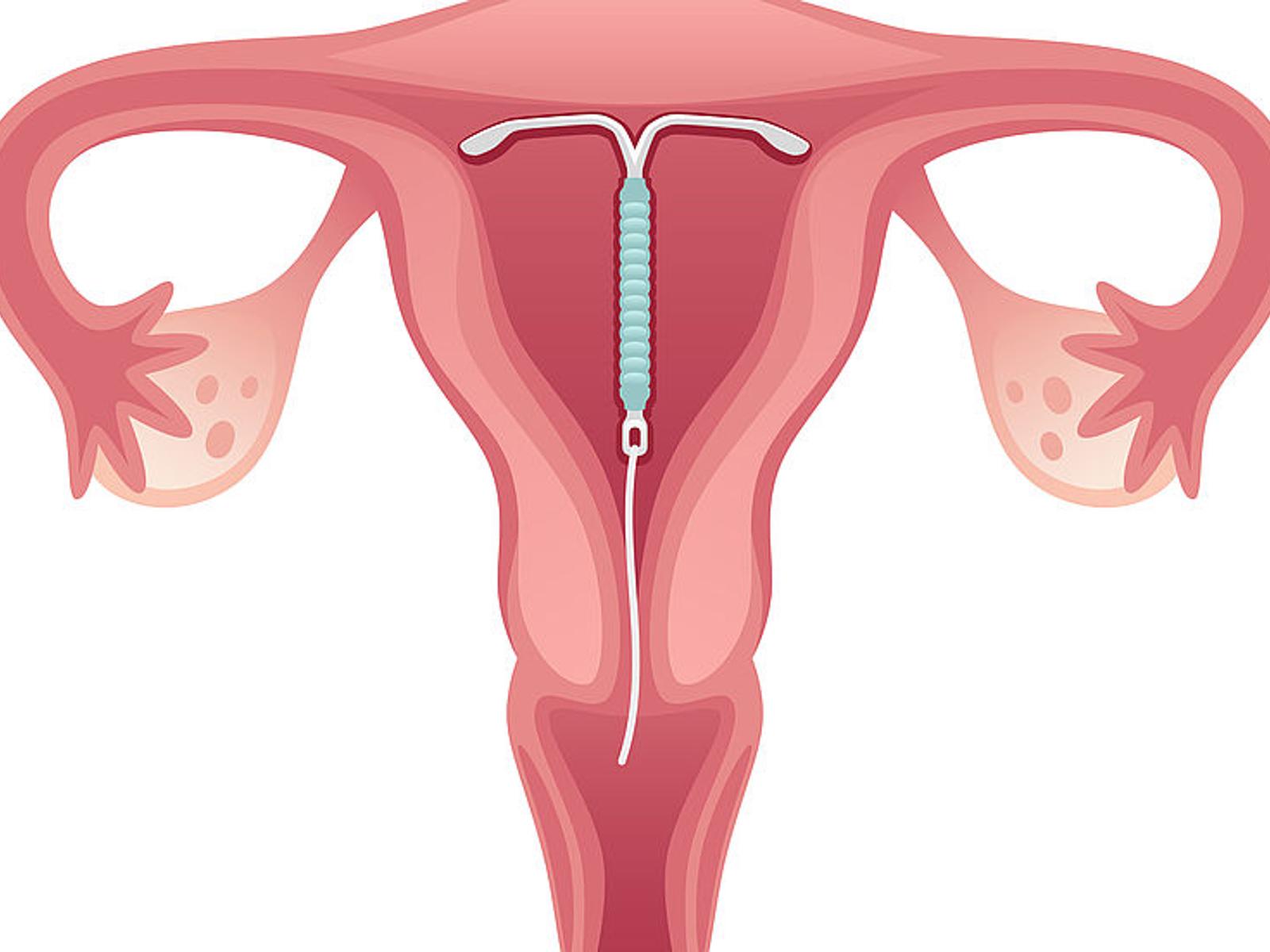 wie wird spirale eingesetzt