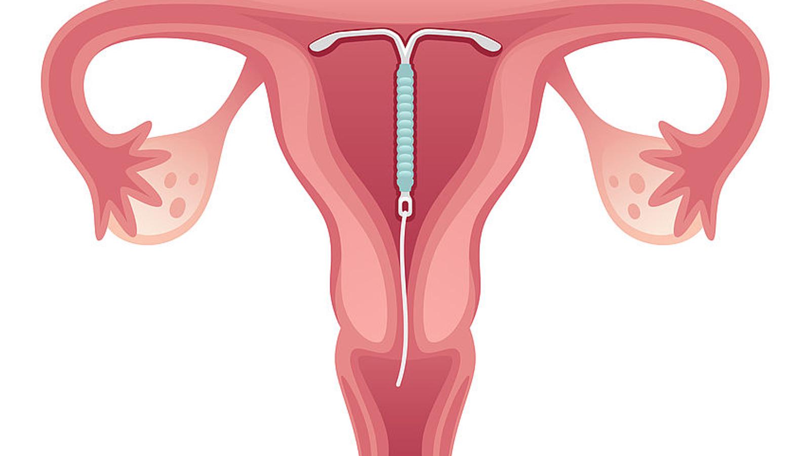 Abbildung: Spirale in der Gebärmutter