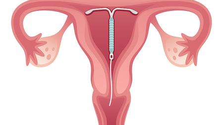 Abbildung: Spirale in der Gebärmutter