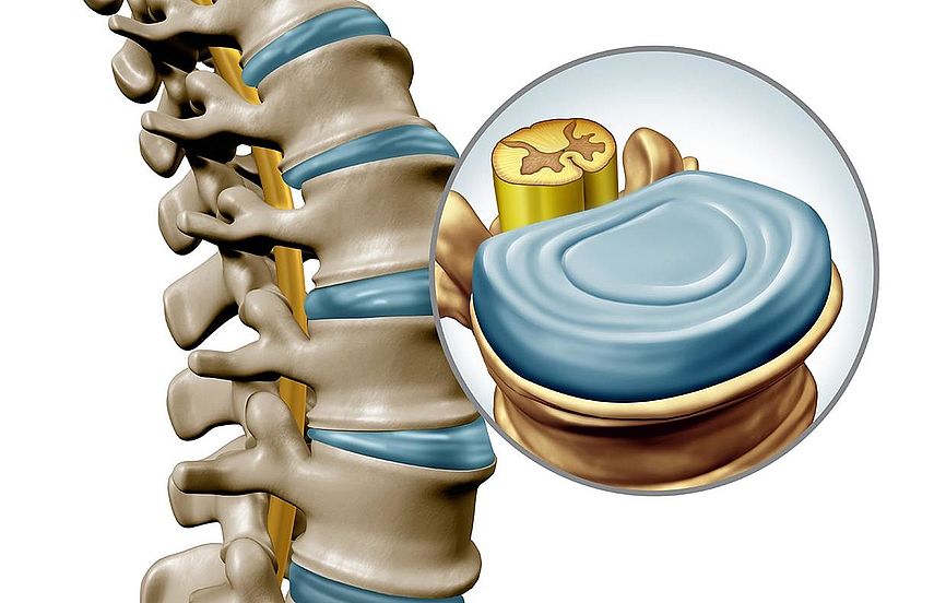 Zervikalsyndrom (HWS Syndrom) » Symptome & Behandlung | MeinMed.at