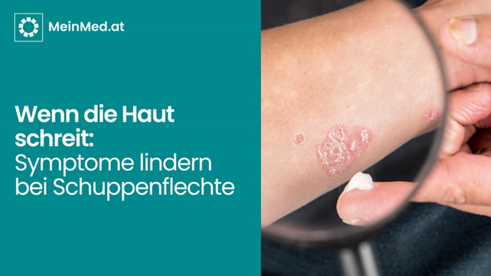Wenn die Haut schreit! Symptome lindern bei Schuppenflechte