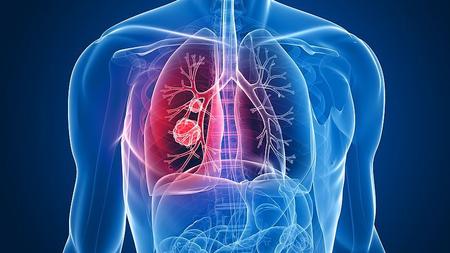 Abbildung eines Lungenkrebs