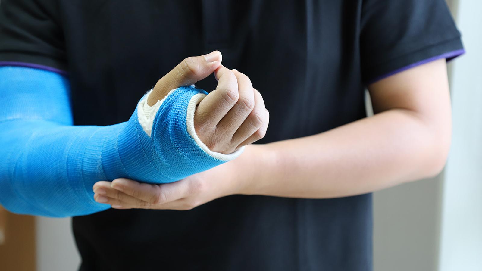 Gebrochene Hand in einem Gips