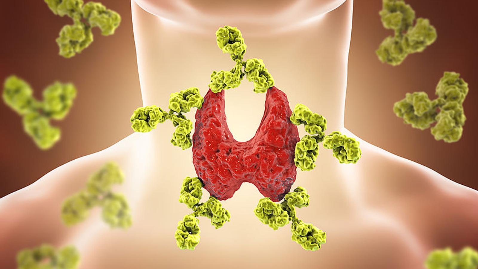 Bei Hashimoto-Thyreoiditis greift das Immunsystem die Schilddrüse an