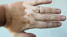 Vitiligo am Handrücken