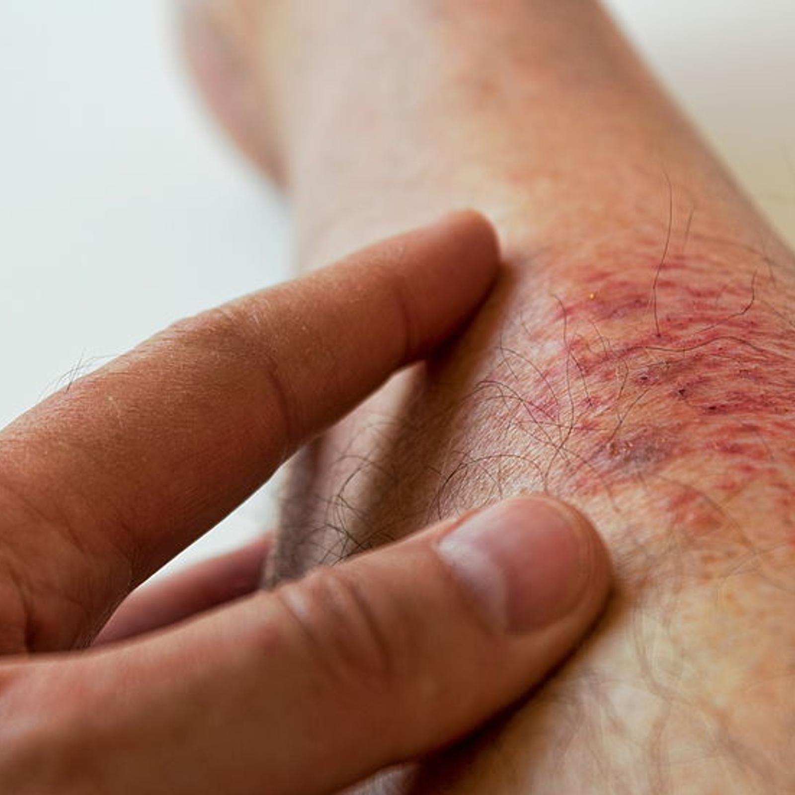 Ekzem  Ursache, Symptome und Behandlung des Hautausschlages | MeinMed.at