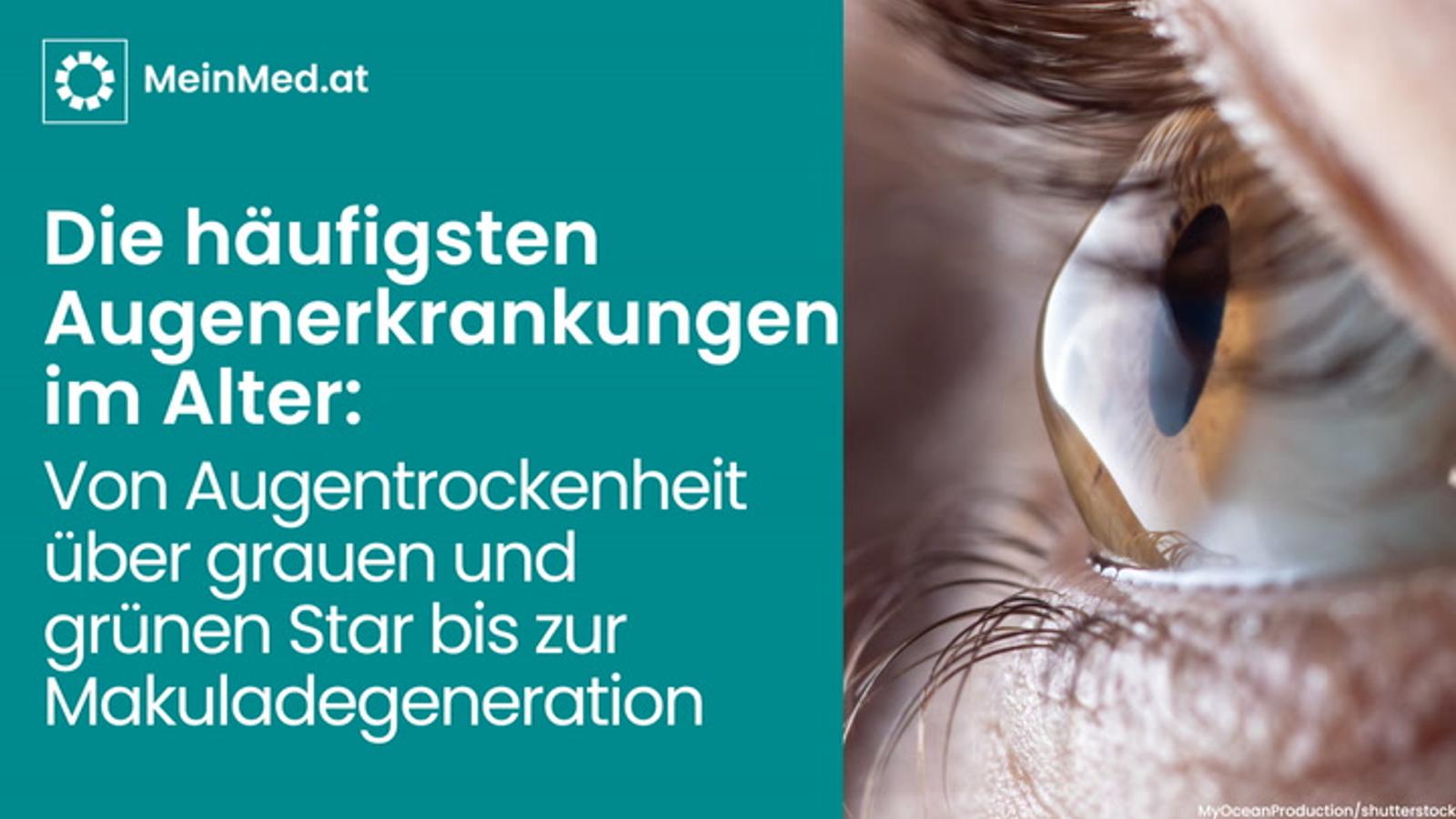 Die häufigsten Augenerkrankungen im Alter: Von Augentrockenheit über grauen und grünen Star bis zur Makuladegeneration