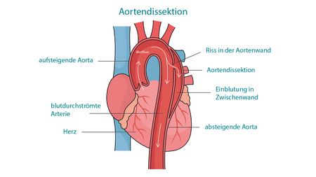 Grafik, die das Herz und die Aorta zeigt