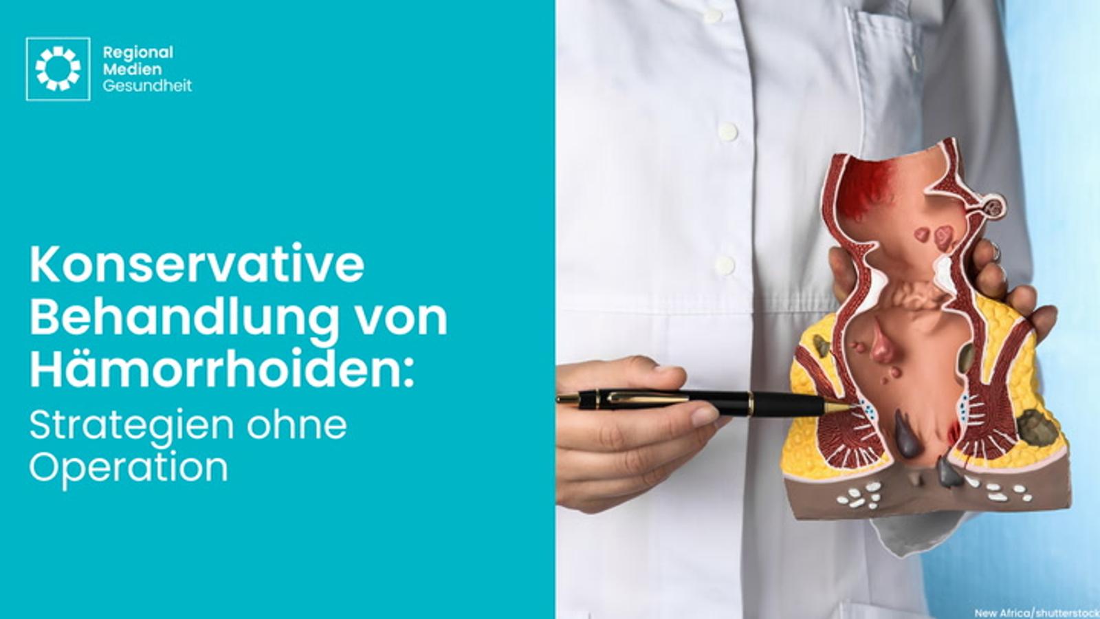 Konservative Behandlung von Hämorrhoiden: Strategien ohne Operation