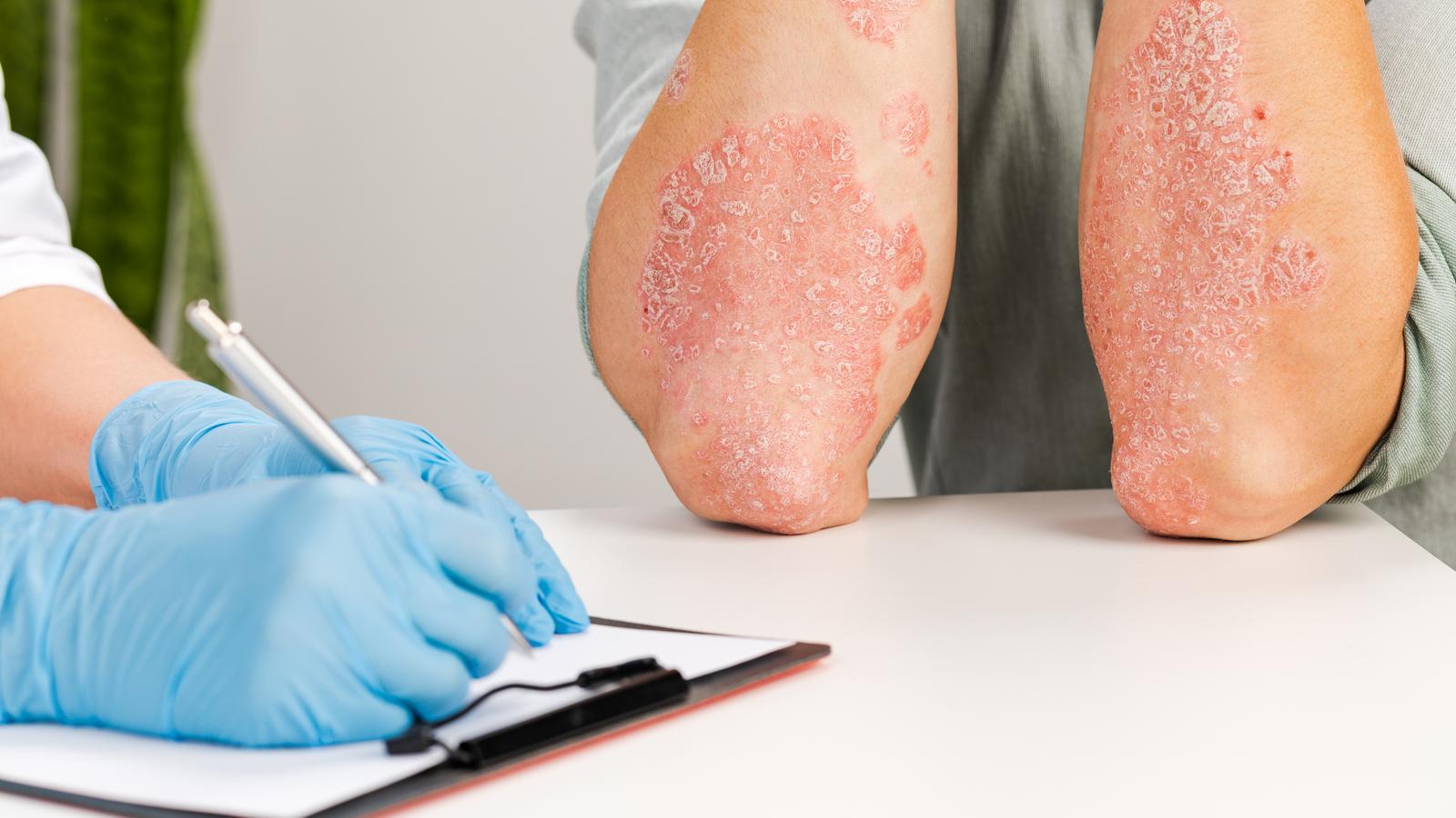 Psoriasis