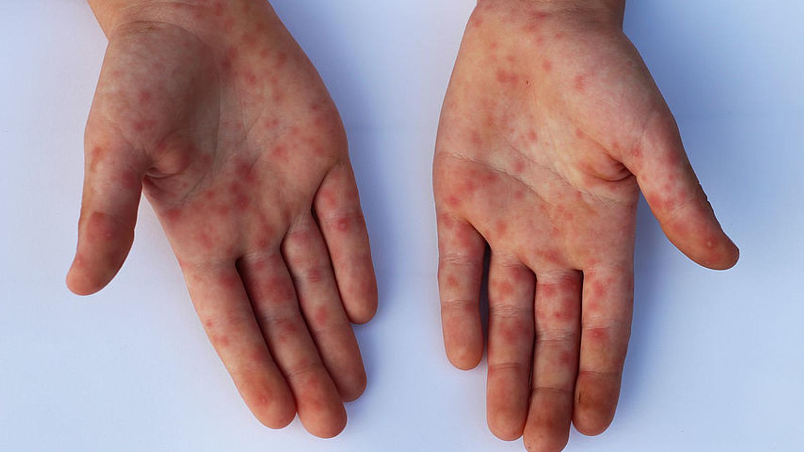 Mund Hand Fuss Bei Erwachsenen Hand-Fuß-Mund-Krankheit » Symptome | MeinMed.at