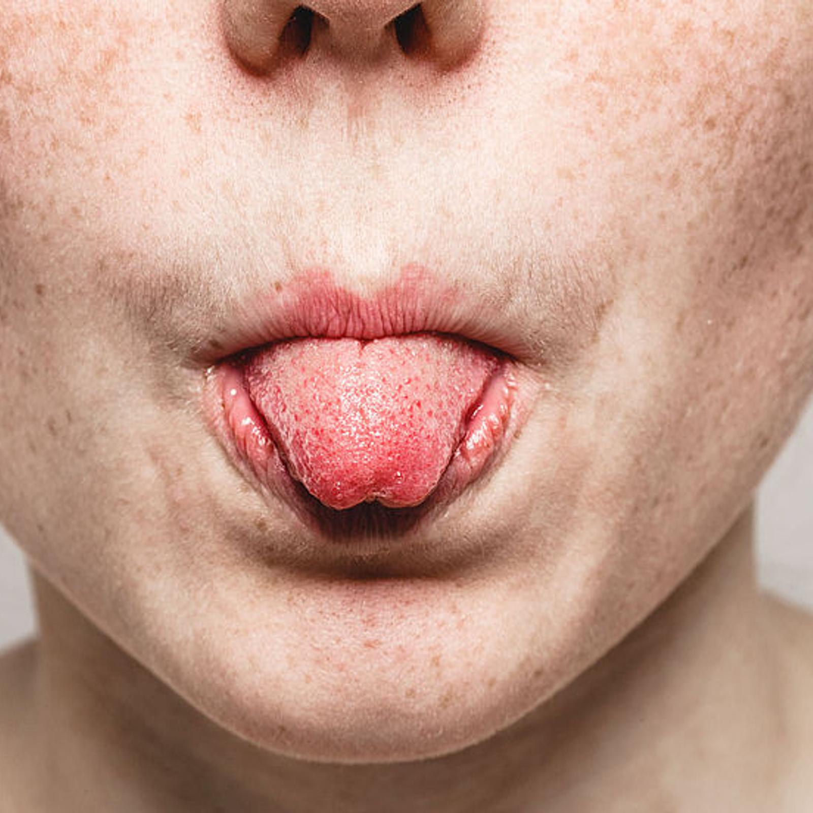 Zunge  10 Dinge, die sie ber die Gesundheit verrt | MeinMed.at