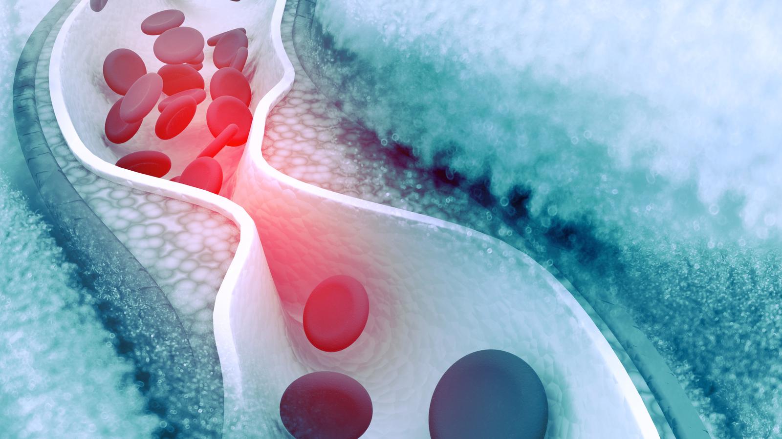 DFP-Praxiswissen: Hypercholesterinämie