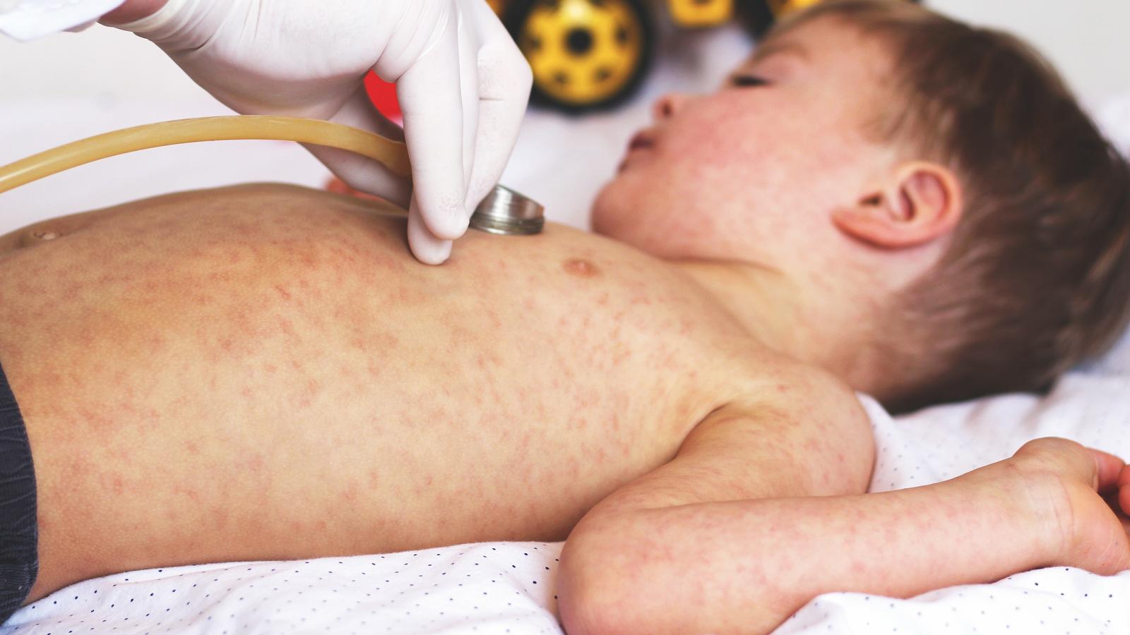 Masern: Durchimpfungsziel in weiter Ferne Kleinkind mit Masern
