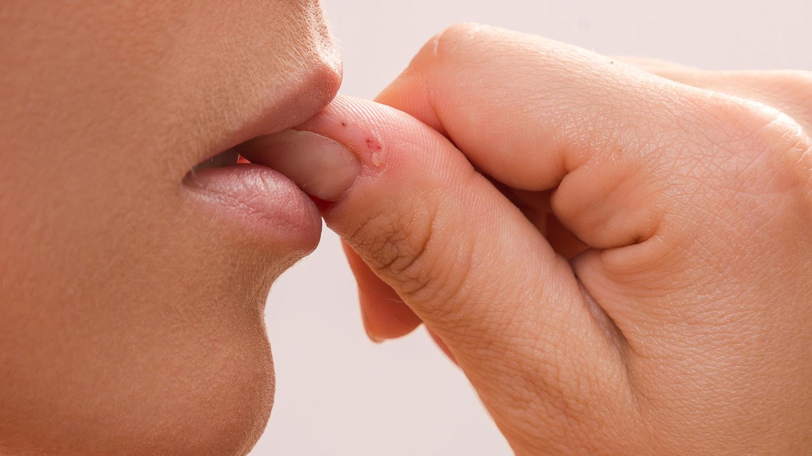 Fingerhaut beißen & essen bei Dermatophagie