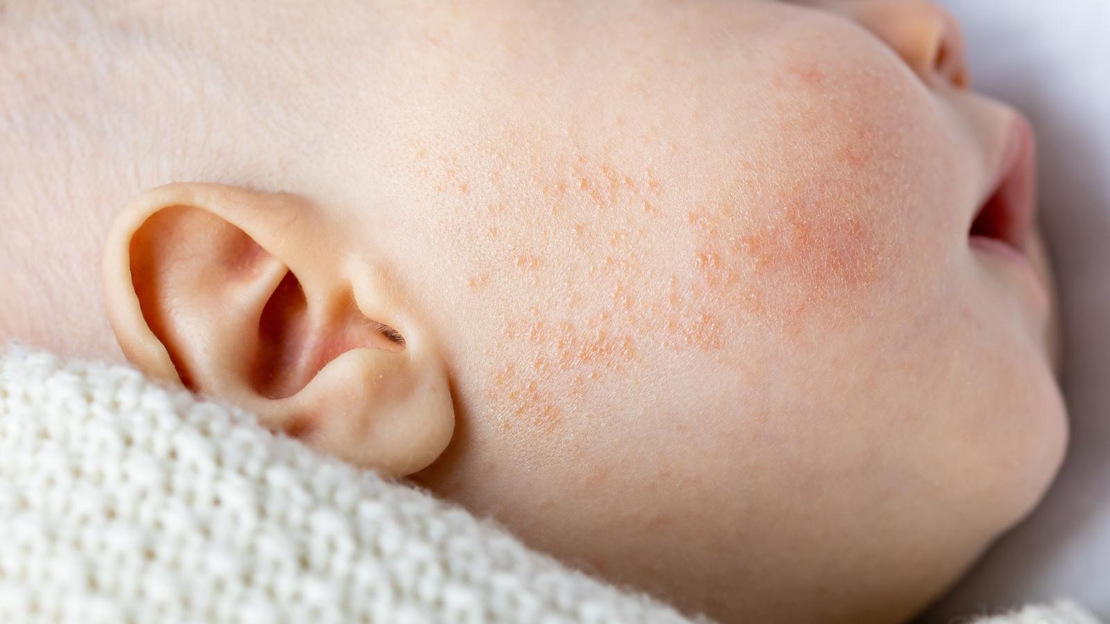 Babyakne auf Haut von Neugeborenen