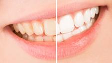 Darstellung zeigt wie viel heller die Zähne nach dem Bleaching als vorher sind