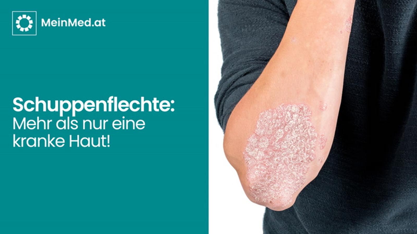 Schuppenflechte – mehr als nur eine kranke HAUT!