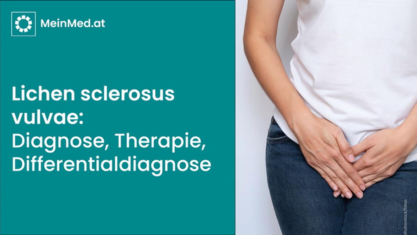 Lichen sclerous vulvae: Diagnose, Differentialdiagnose & Therapie