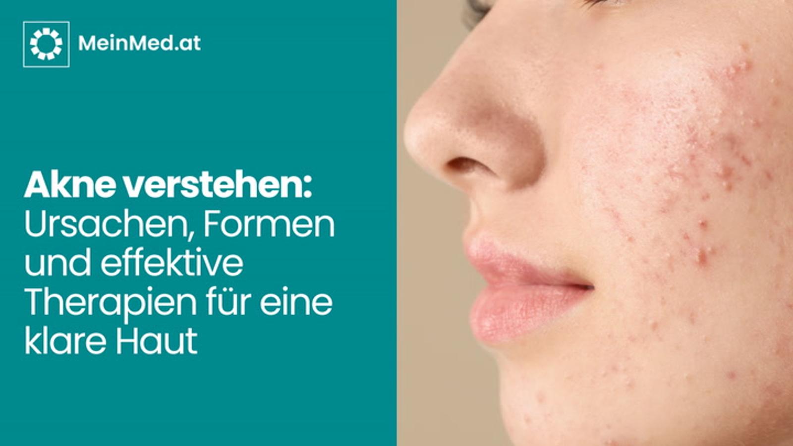 Akne verstehen: Ursachen, Formen und effektive Therapien für eine klare Haut