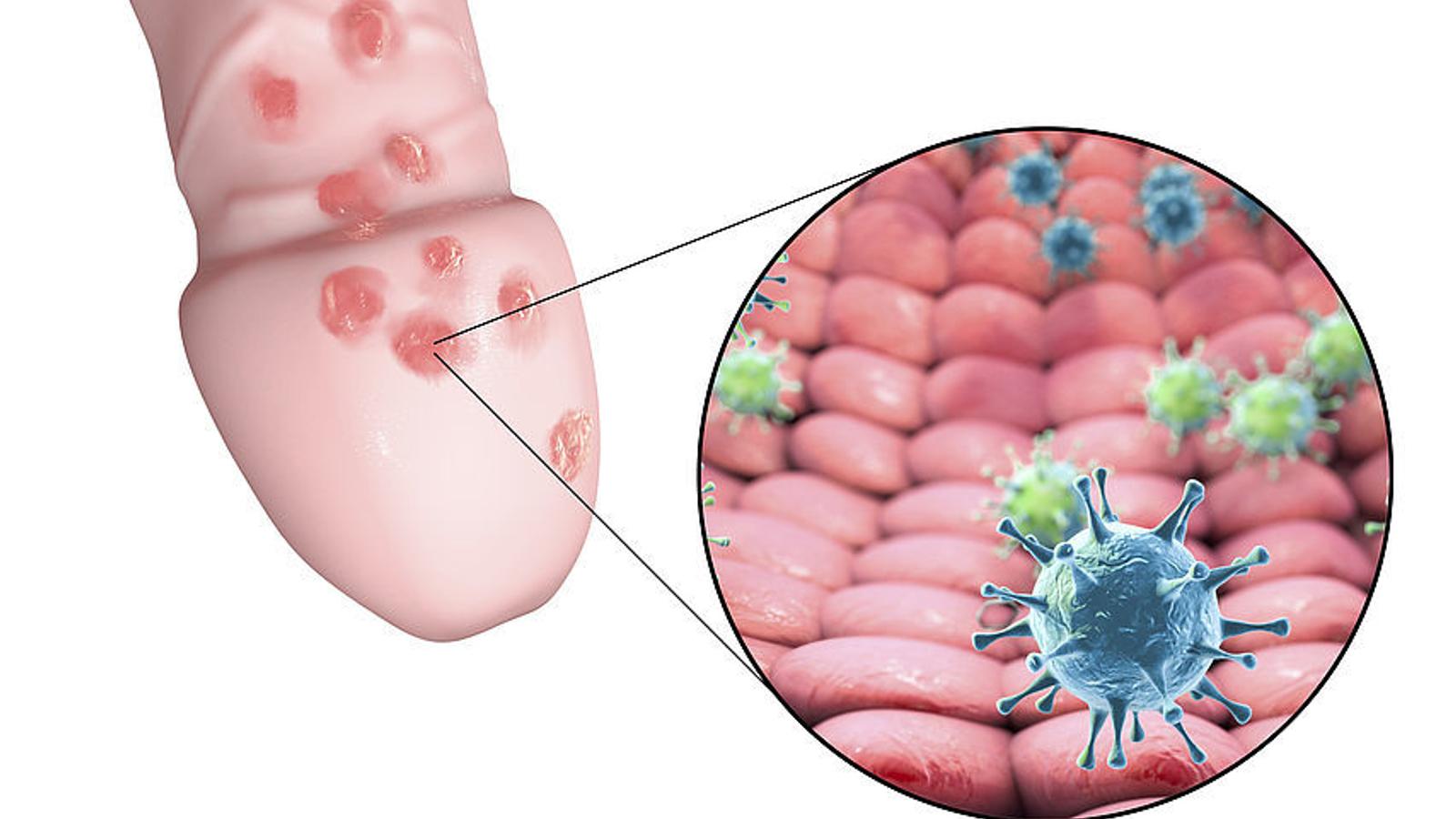 Abbildung eines Penis mit Herpes genitalis