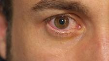 Nahaufnahme eines Auges mit Bindehautentzündung