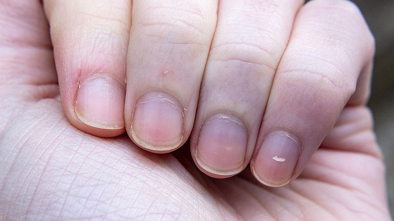 Fingernägel mit weißen Flecken eines Menschen mit Mangelernährung