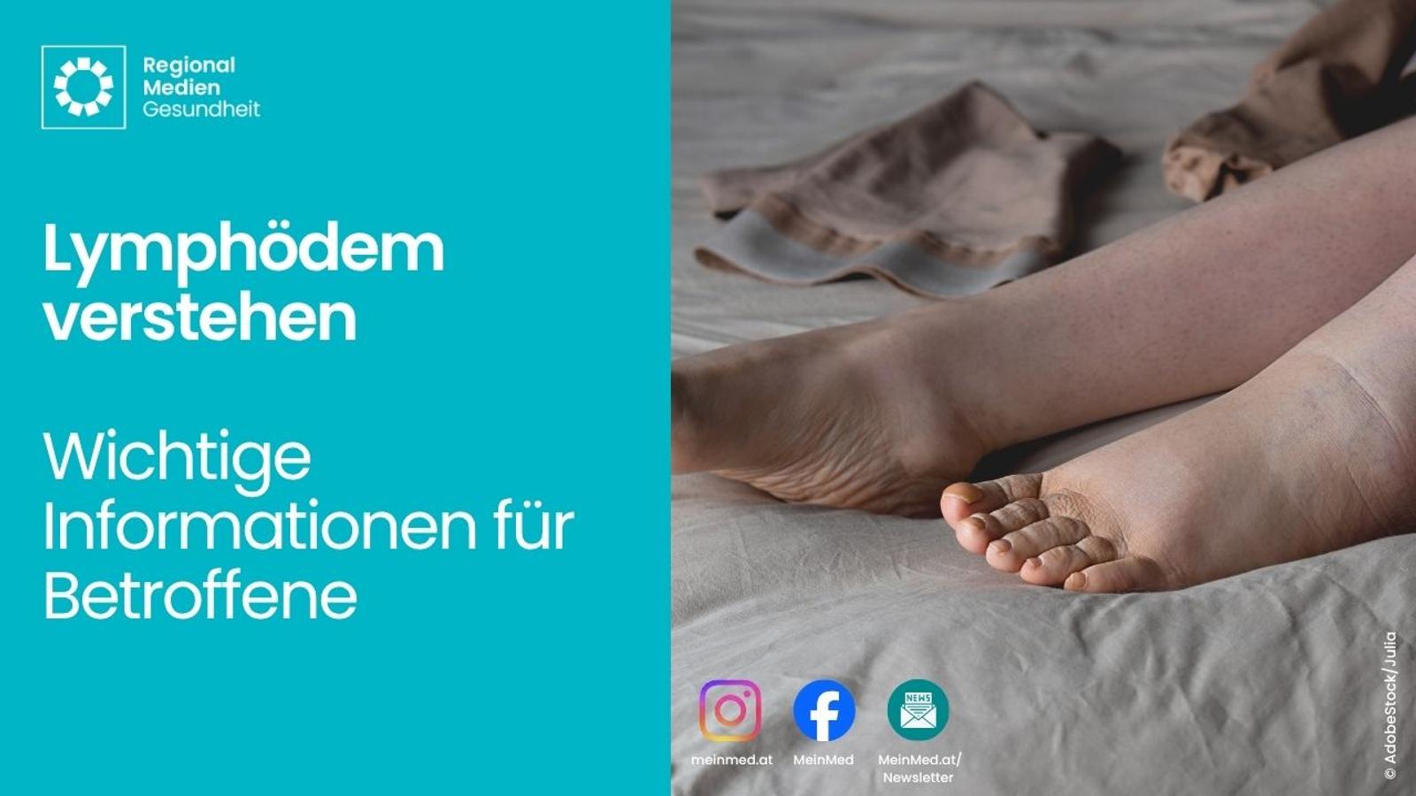 Webinar Thumbnail   Lymphoedem