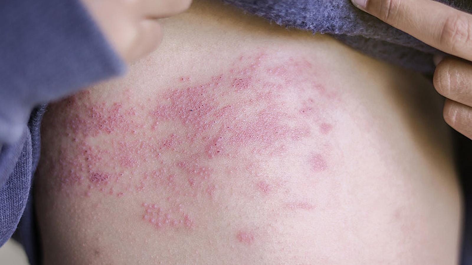 Gürtelrose wird vom Varizella-Zoster-Virus verursacht Kind zeigt seinen Oberkörper mit Gürtelrose