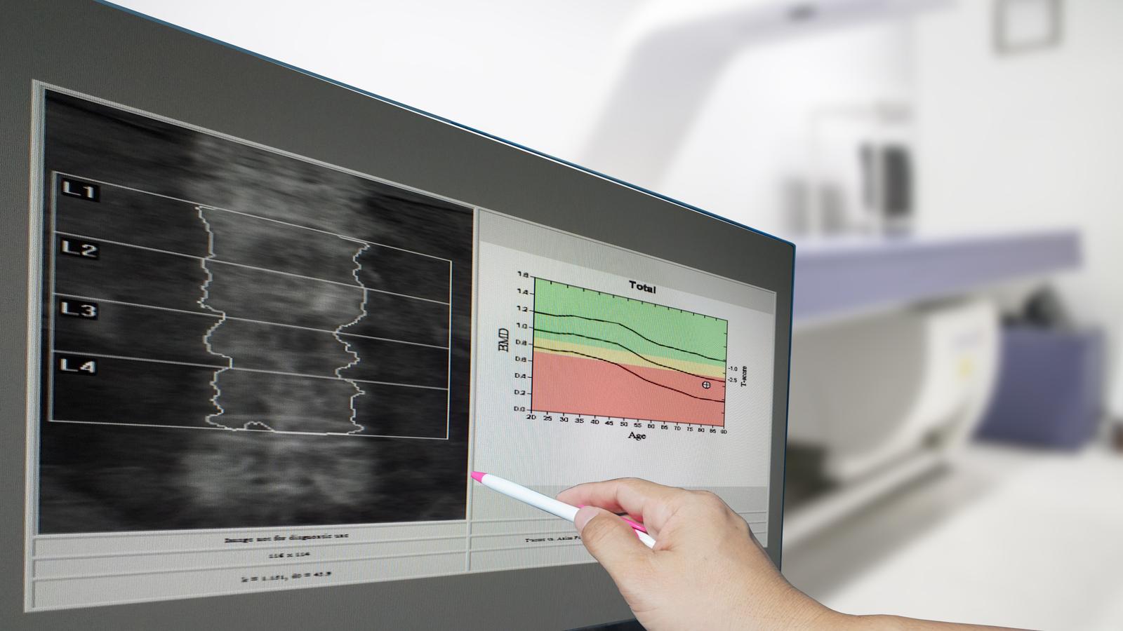 Osteoporose bei Knochendichtemessung festgestellt