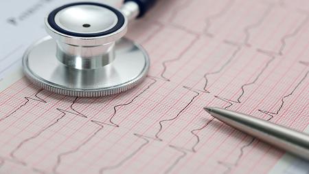 Elektrokardiogramm des Herzens