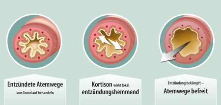 Artikelbild zu Artikel: Asthma: Die Entzündung mit Kortison behandeln